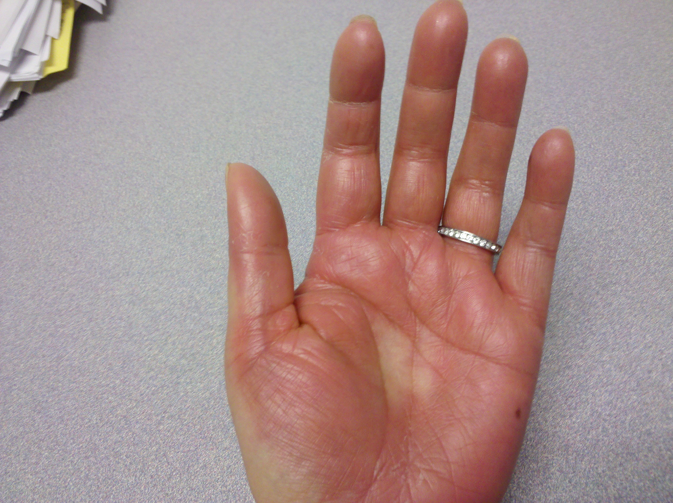 Top 11 Doctor Insights on shingles rash on hands - HealthTap